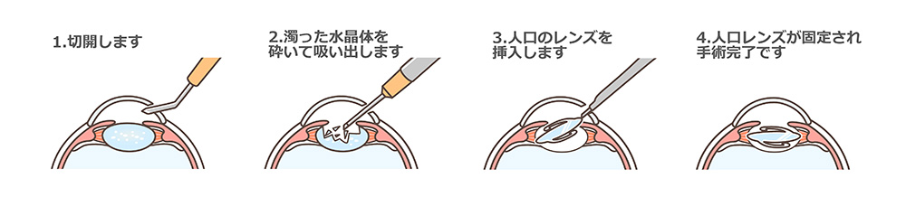 白内障の手術